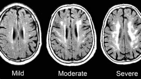  &0183;&32;Current evidence on the impact of Mediterranean diet (MeDi) on white matter hyperintensity (WMH) trajectory is scarce. . Best diet for white matter disease